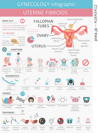 Uterine fibroids. Ginecology medical infographic 41643412