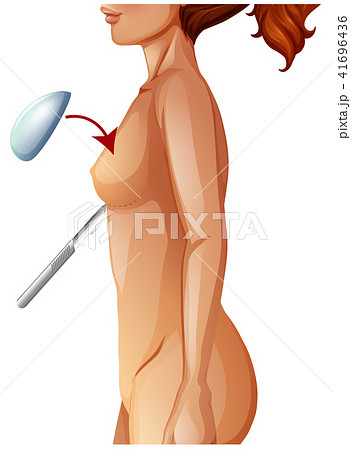 A Human Anatomy Breast Augmentation 41696436
