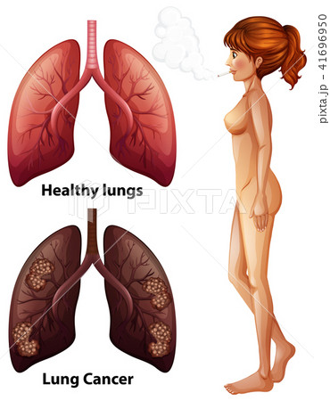 Human Anatomy Lung of Smoker Human Anatomy Lung of Smoker 41696950
