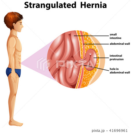 A Human Anatomy Strangulated Hernia A Human Anatomy Strangulated Hernia 41696961