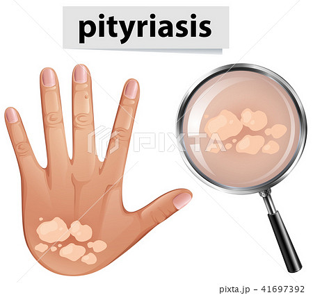 A Vector of Pityriasis on Human Skin A Vector of Pityriasis on Human Skin 41697392