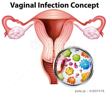 Vaginal infection bacteria concept 41697476