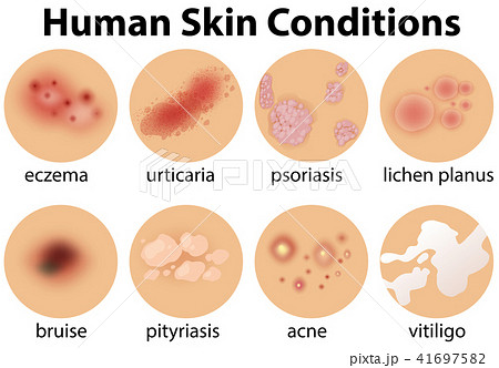 A Set of Human Skin Conditions A Set of Human Skin Conditions 41697582