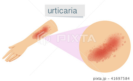 A Human Skin Problem Urticaria 41697584