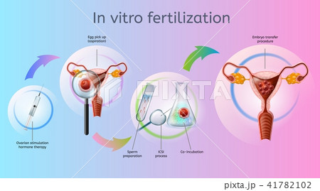In Vitro Fertilization Procedures Vector Scheme 41782102