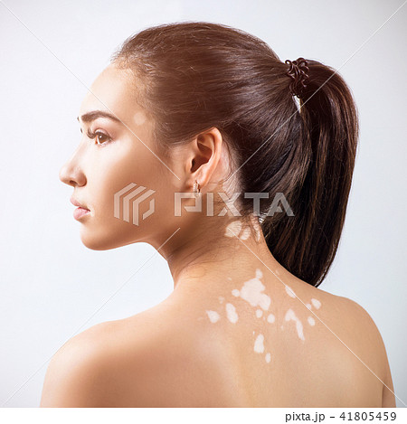 Portrait of beautiful woman with vitiligo. Portrait of beautiful woman with vitiligo. 41805459