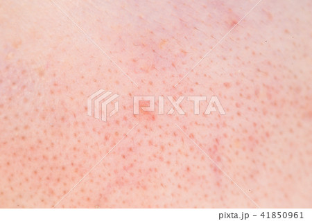 close up of black head close up of black head 41850961