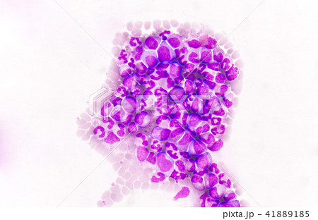 Immature blood cells in leukemia. 41889185