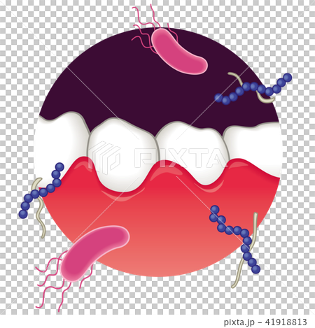 牙齦腫脹牙周病 41918813