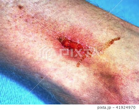 Fresh affected bloody skin.  Deep scratches 41924970