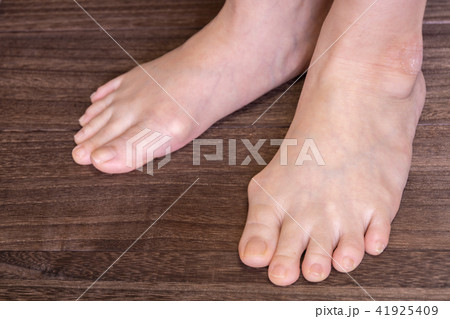 外反母趾 41925409