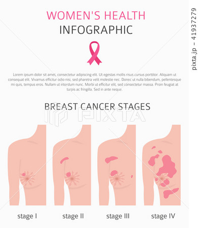 Breast cancer, medical infographic 41937279