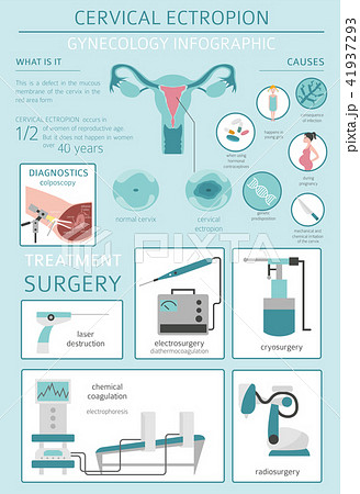 Cervical ectropion. Ginecological infographic 41937293
