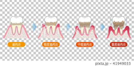 Progression of periodontal disease Progression of periodontal disease 41949033
