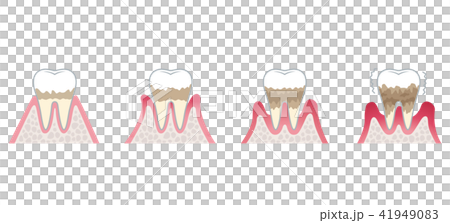 Progression of periodontal disease 41949083