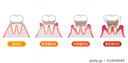 歯周病の進行のイラスト素材