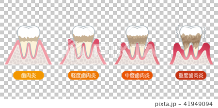 人気のダウンロード 歯肉 炎 イラスト 写真素材 フォトライブラリー