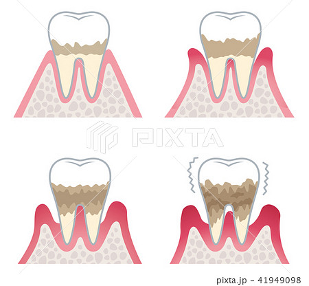 歯周病の進行のイラスト素材