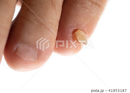 剥がれた足の爪の写真素材