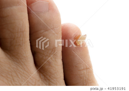 剥がれた足の爪の写真素材