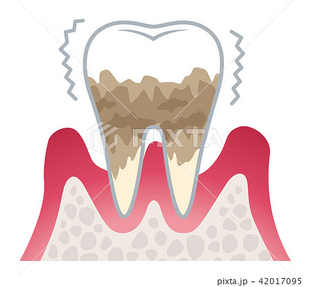 歯周病の進行 42017095