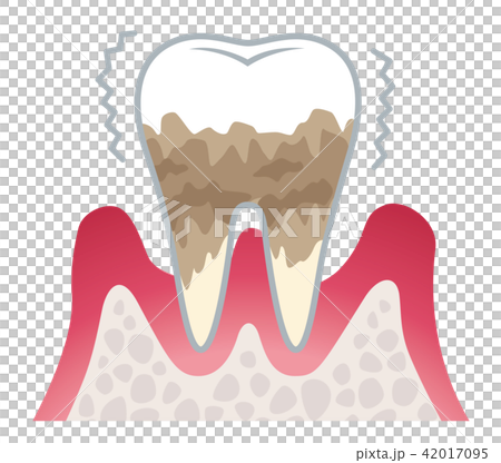 歯周病の進行 42017095