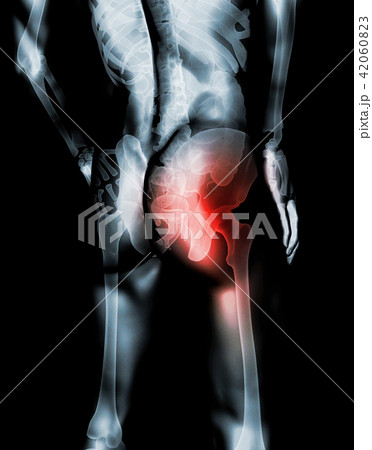 Hip painful skeleton x-ray, 3D illustration. 42060823