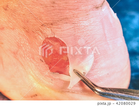 Detail of devastated skin cleaning by medic hands. 42080029