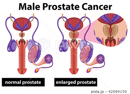 prostate Human Male Prostate Cancerのイラスト素材 [42094150] - PIXTA