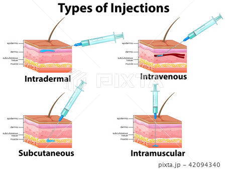 A Set of Type of Injections A Set of Type of Injections 42094340