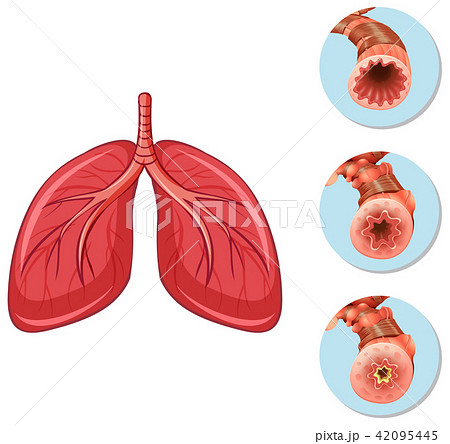 Stages of block airway to lungs Stages of block airway to lungs 42095445