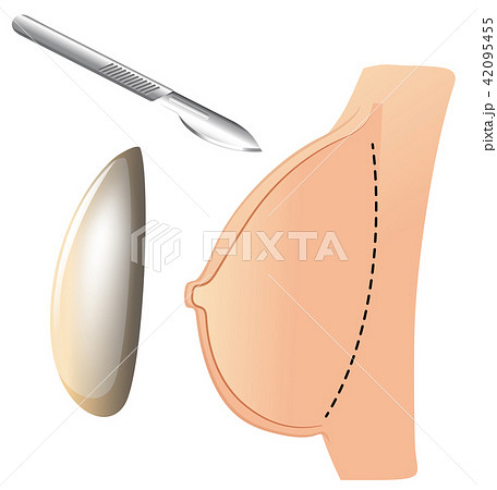 Breast augmentation with implant and knife 42095455