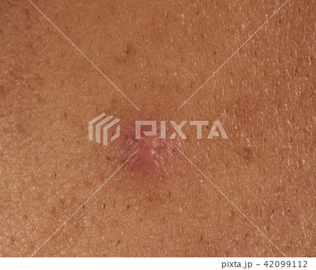 Pink pimple on human skin Pink pimple on human skin 42099112
