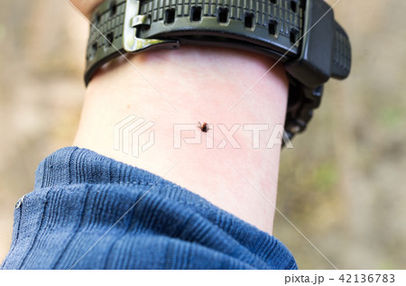 The tick bites his hand. Mite under the skin. 42136783