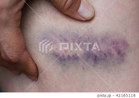 bruise injury on young woman thigh bruise injury on young woman thigh 42165118
