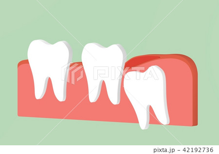 wisdom tooth ( angular or mesial impaction ) wisdom tooth ( angular or mesial impaction ) 42192736