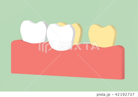 tooth whitening by veneers teeth 42192737