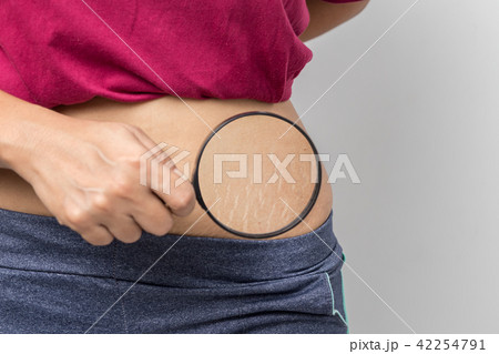 Women Show off the belly after birth.Stretch Marks Women Show off the belly after birth.Stretch Marks 42254791