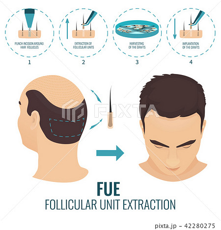 Fue Hair Loss Treatmentのイラスト素材