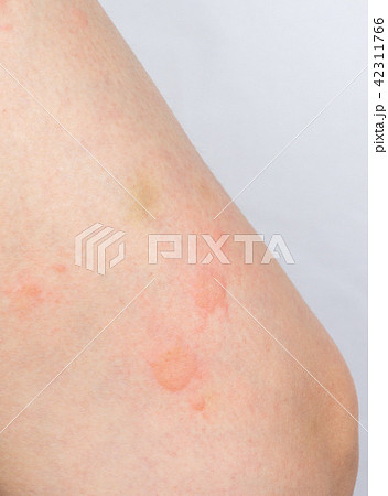 じんましんまみれの脚 42311766