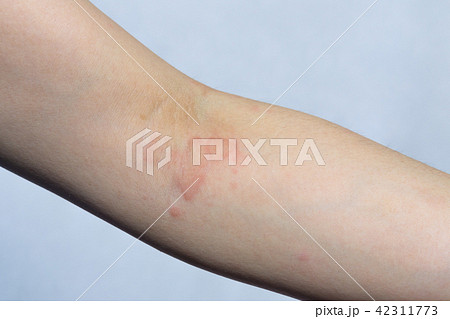 じんましんまみれの腕 42311773