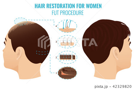FUT hair loss treatment FUT hair loss treatment 42329820