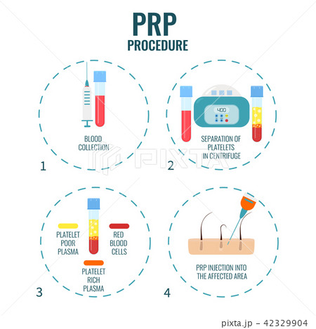 PRP treatment poster 42329904