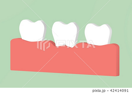 tooth periodontitis or gingivitis, gum disease tooth periodontitis or gingivitis, gum disease 42414091