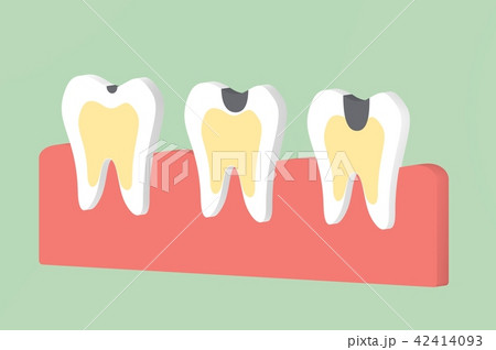 step of decay tooth 42414093