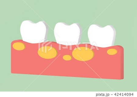 gingivitis with abscess in gum gingivitis with abscess in gum 42414094