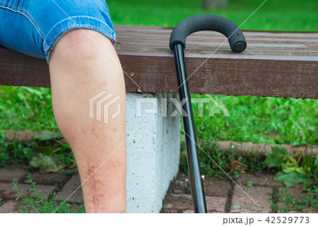 Scared leg on the bench with a cane 42529773