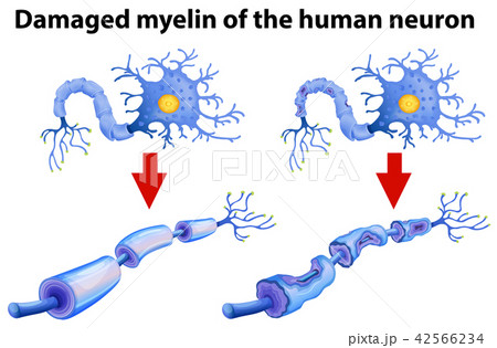 Dammaged Myelin Of The Human Neuronのイラスト素材