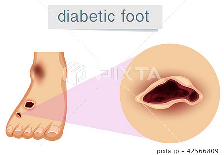 A human foot with diabetic 42566809