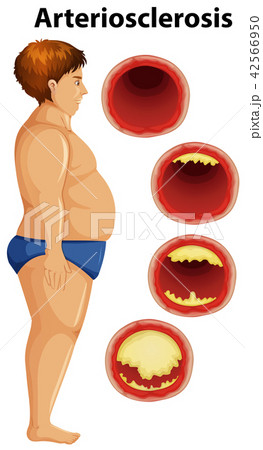 Fat man and arteriosclerosis Fat man and arteriosclerosis 42566950